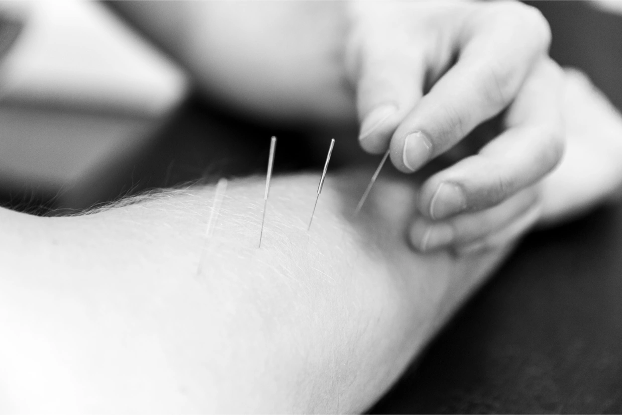 Käsi, johon asetetaan akupunktioneuloja. Kuva havainnollistaa akupunktion hoitomenetelmää, jossa käytetään ohuita neuloja kivunlievitykseen ja rentoutumiseen.