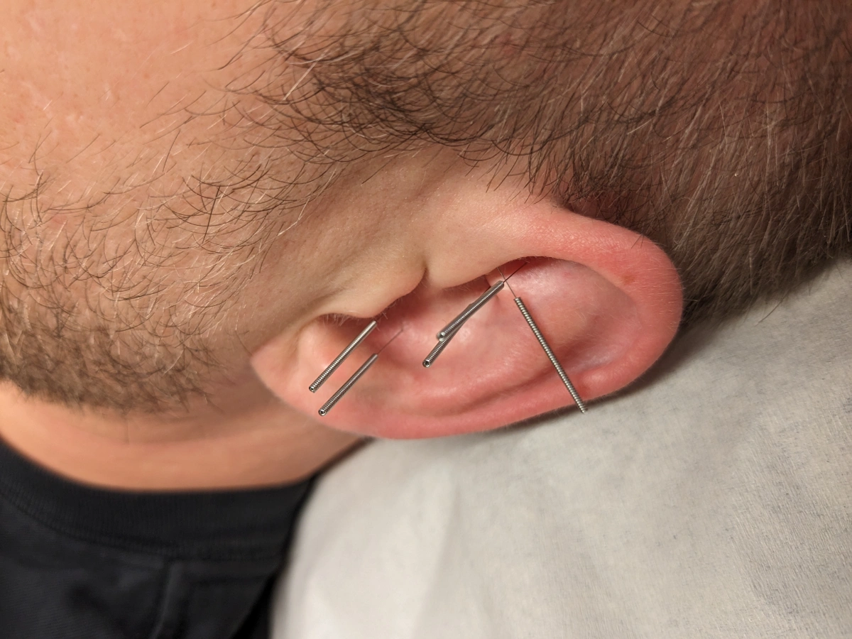 korva-akupunktio neulat korvassa